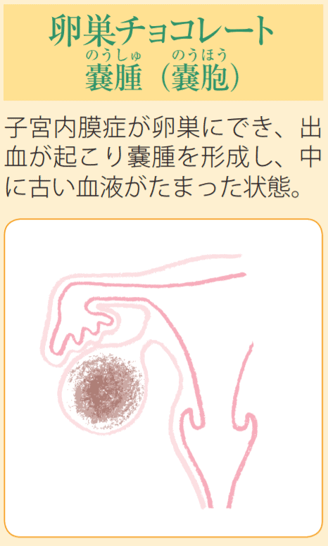 チョコレート嚢 の う腫 し ゅの破裂が怖い でも手術で卵巣機能が 低下してしまうのでは 医師監修 ジネコ不妊治療情報