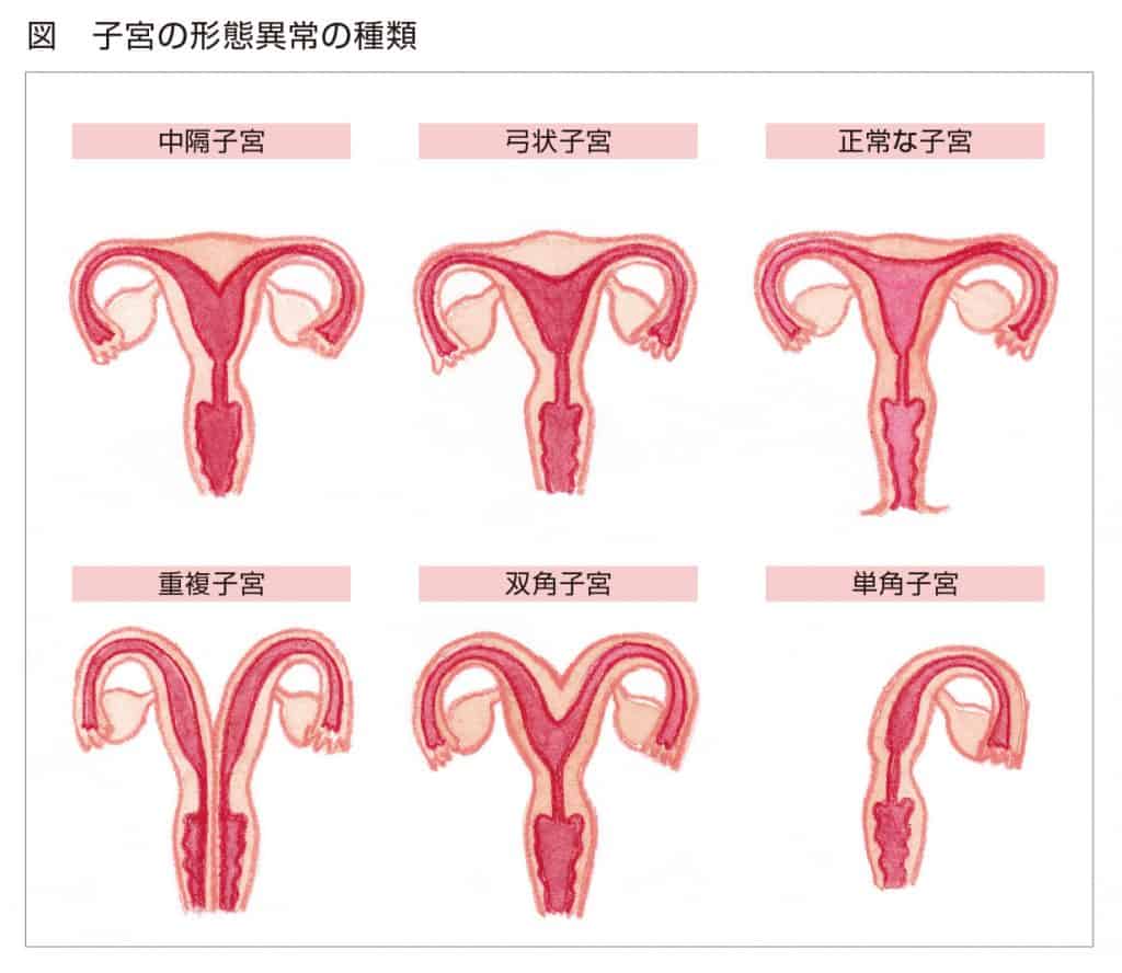 単角子宮のため自然妊娠するも流産 今後の有効な治療法は 医師監修 ジネコ不妊治療情報