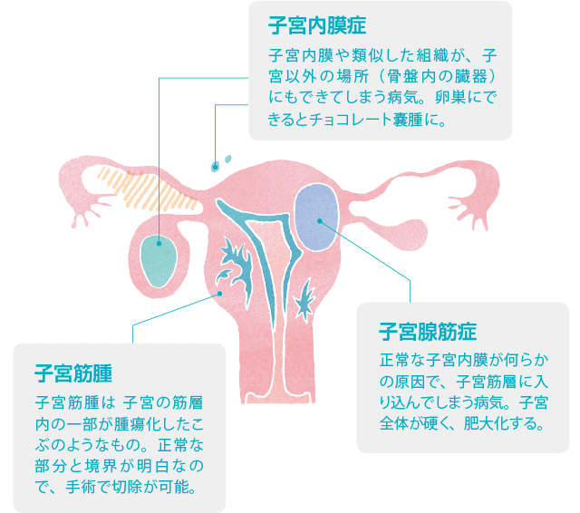 子宮内膜症があります 9回胚移植していますが 着床しないのはなぜ 医師監修 ジネコ不妊治療情報