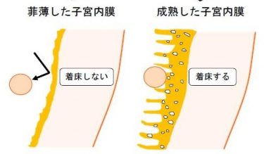 白いかたまりが出てきたら流産 医師監修 ジネコ不妊治療情報