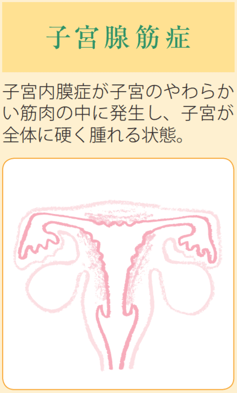 子宮腺筋症の治療法は この病気だとやはり妊娠は難しいですか 医師監修 ジネコ不妊治療情報