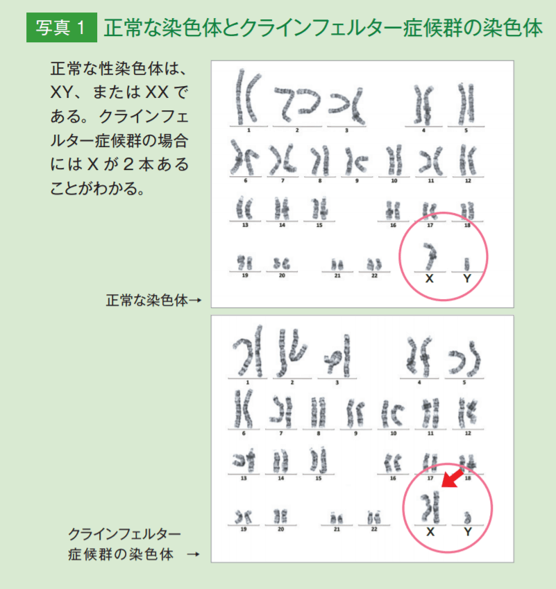フェルター 症候群 クライン