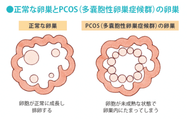 ＰＣＯＳとはどんな病気？