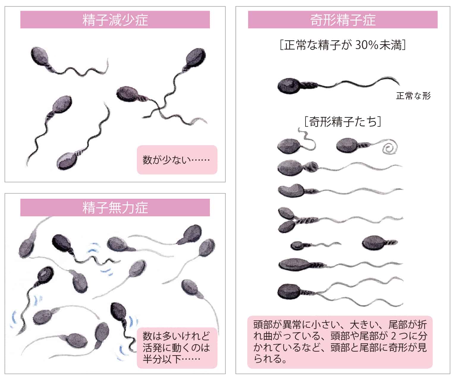 男性不妊 医師監修 ジネコ不妊治療情報