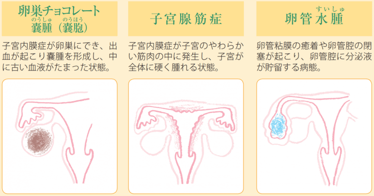 子宮内膜症が判明 医師監修 ジネコ不妊治療情報