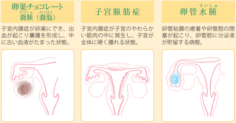 子宮内膜症が判明。 │【医師監修】ジネコ不妊治療情報