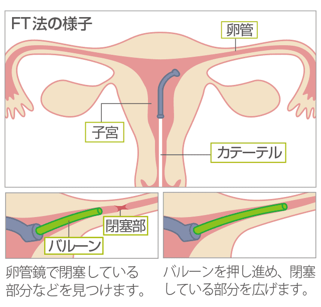 卵管通水検査で両側卵管完全閉塞│【医師監修】ジネコ不妊治療情報